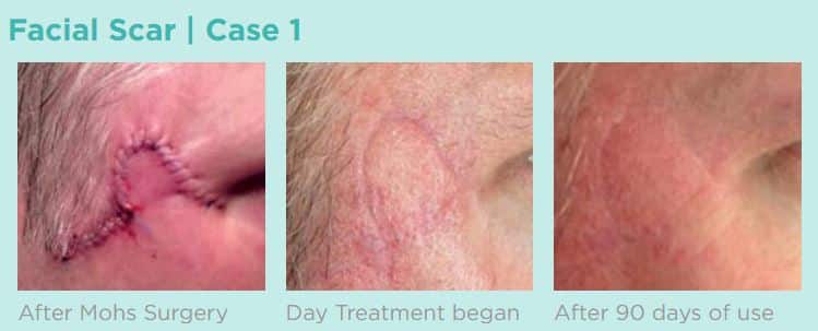 Patient after mohs surgery, the day scar treatment began, and 90 days later.