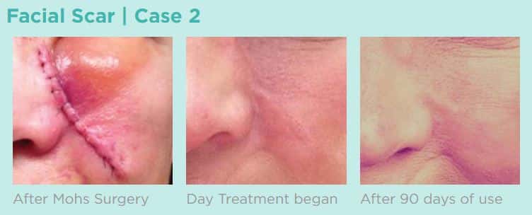 Patient after mohs surgery, the day scar treatment began, and 90 days later.