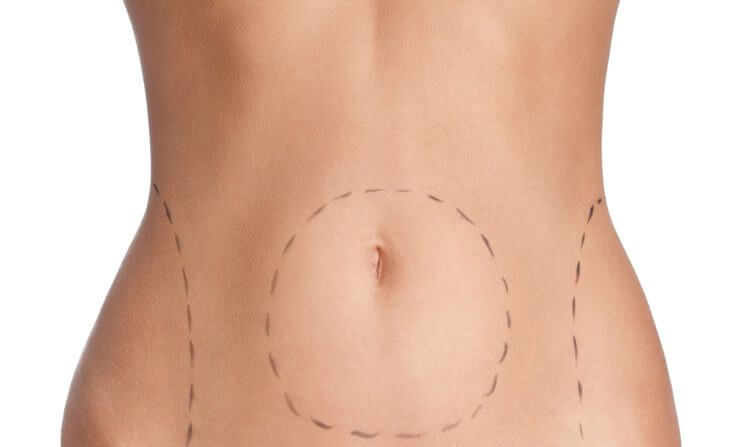 Liposuction Circles