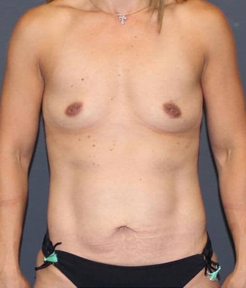 liposuction in denver