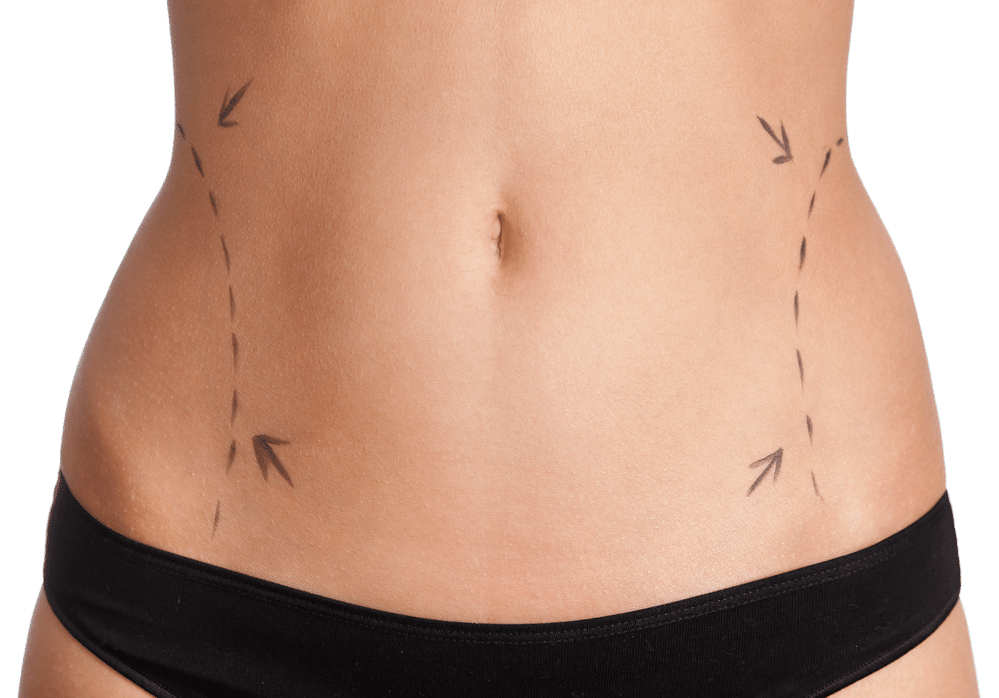 belly liposuction