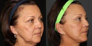 Facelifts Before and After | Murphy Plastic Surgery
